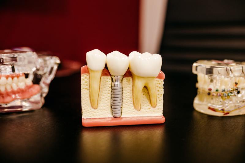 Dental Implants In Coral Gables