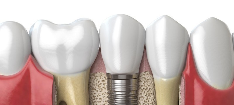 Dental implants Coral Gables Fl