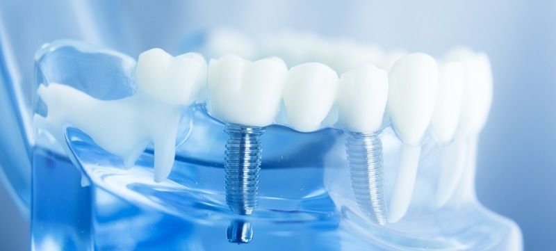 dental-implants in CORAL GABELS FL