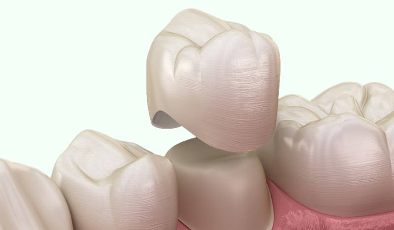 Dental Crowns in Coral Gables