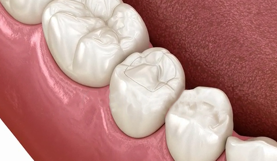 Composite Dental Fillings in Coral Gables